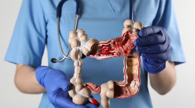 Não importa a sua idade, não ignore esses sintomas do câncer de intestino